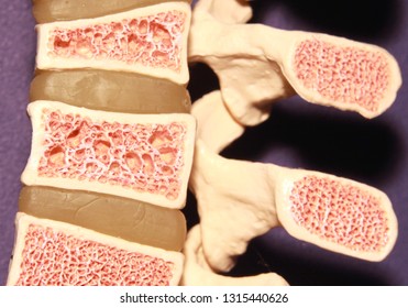 Model Of Spine Showing Porous Bone Marrow In Case Of Osteoporosis