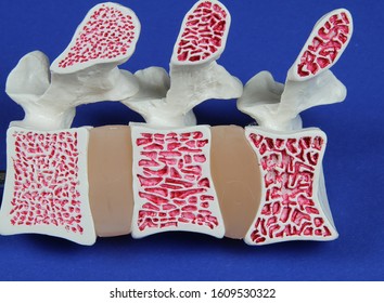 Model Of Spine Showing Porous Bone Marrow In Case Of Osteoporosis