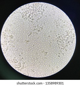 high white blood cell count in urine