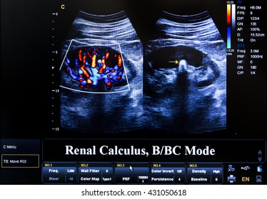 Modern Echocardiography (ultrasound) Machine Monitor. Colour Image. New Hospitl Equipment. Renal Calculus.