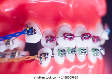 Modern metal retainers and plastic algners wire dental brackets teeth straighteners.