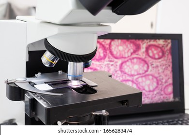Modern microscope and human tissue section slide with computer monitor show glandular image.Medical patholology and cytologytechnology concept.Selective focus.