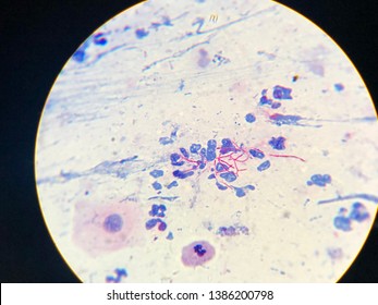 Modified Acid Fast Stain Positive, Nocardia, Acid-fast Beaded Branching Filaments