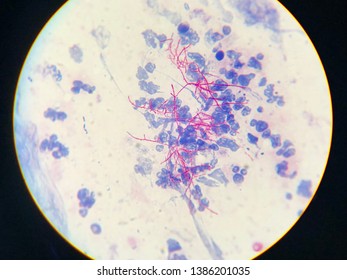 Modified Acid Fast Stain Positive, Nocardia, Acid-fast Beaded Branching Filaments