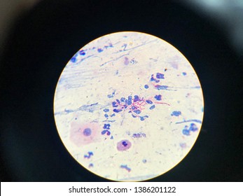 Modified Acid Fast Stain Positive, Nocardia, Acid-fast Beaded Branching Filaments