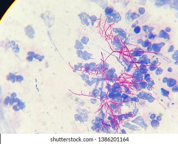 Modified Acid Fast Stain Positive, Nocardia, Acid-fast Beaded Branching Filaments