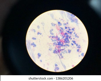 Modified Acid Fast Stain Positive, Nocardia, Acid-fast Beaded Branching Filaments