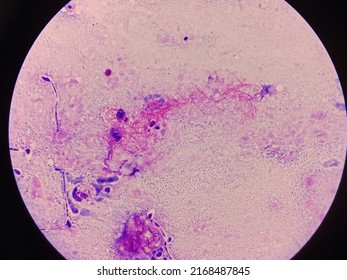 Modified Acid Fast Stain Positive, Nocardia In Sputum. Acid Fast Branching Filaments.