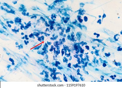 Modified AFB Stain ( Nocardia Species)