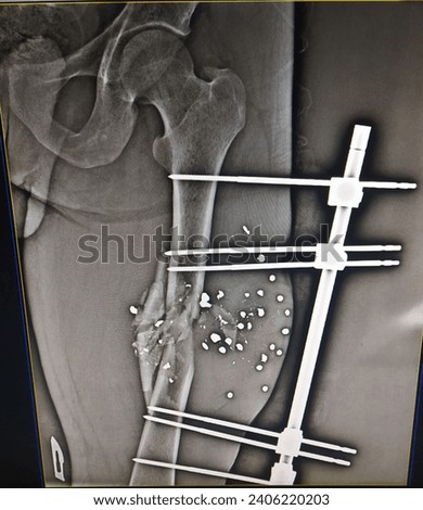 A modified open middle femur fracture resulting from a gunshot wound in a young man. It was managed urgently