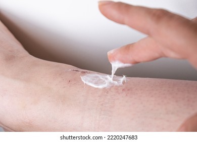 Moisturizing Cream Applied To The Leg, Psoriasis, Damaged Leg Skin, Eczema. Inflamed, Very Bad Skin, Dry, Eczema, Atopic Dermatitis On The Leg. Allergy-damaged Skin On The Leg, Rash