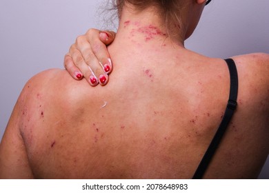 Moisturizing Skin With Severe Atopic Dermatitis In A Young Girl. Dermatology, Skin Problems