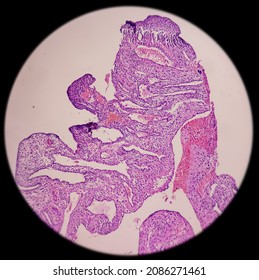 Molar pregnancy(curettage), microscopic image compatible with hydatidiform mole, show hydrophic swelling of chorionic villi, decidual tissue and hemorrhage. It's very rare, no malignancy seen.
