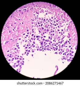 Molar pregnancy(curettage), microscopic image compatible with hydatidiform mole, show hydrophic swelling of chorionic villi, decidual tissue and hemorrhage. It's very rare, no malignancy seen.