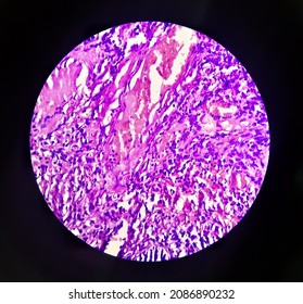 Molar pregnancy(curettage), microscopic image compatible with hydatidiform mole, show hydrophic swelling of chorionic villi, decidual tissue and hemorrhage. It's very rare, no malignancy seen
