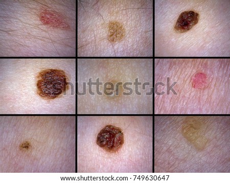 Mole Abnormal Color 