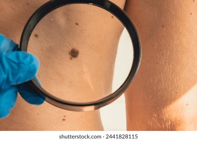 Mole dermoscopy, preventive of melanoma. Dermatologist examining patient's birthmark with magnifying glass in clinic. Checking benign moles. Skin abnormalities care - Powered by Shutterstock