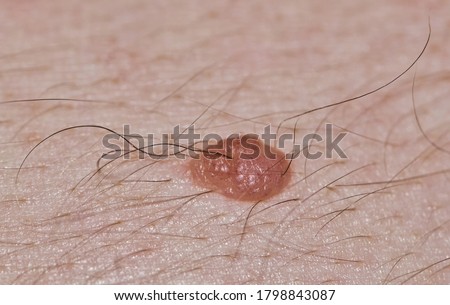 Mole with hair on fair caucasian skin. Dermal mole Melanocytic nevus macro image with copy space and selective focus.