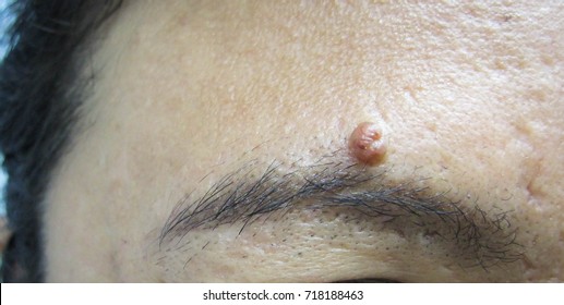 1,187 Eyebrow Scar Images, Stock Photos & Vectors | Shutterstock