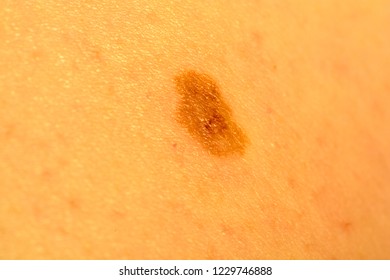 Mole - Melanocytic Nevus 