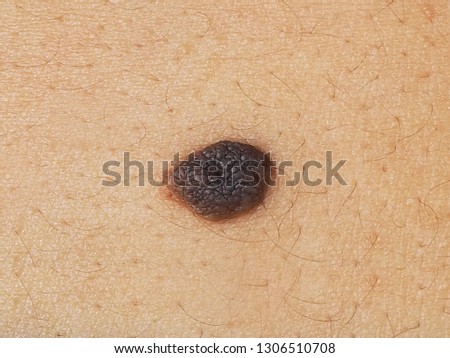 Mole or melanoma black color on back women of skin lesion case of proliferation of pigment derma cells and melanocytic pigmented naevus, Macro shot photo.