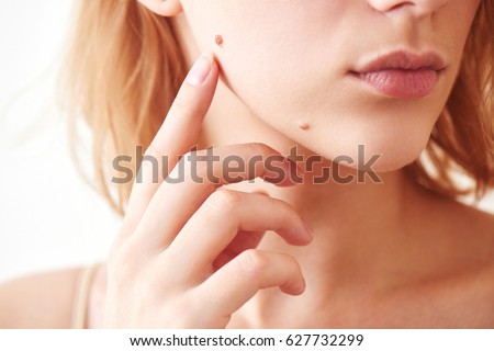 The mole on the girl's face closeup