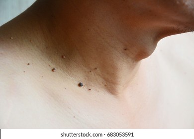 1,752 Moles warts Images, Stock Photos & Vectors | Shutterstock