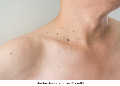 Mole on men's skin isolat white background