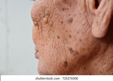 Hairy Mole Images, Stock Photos & Vectors | Shutterstock