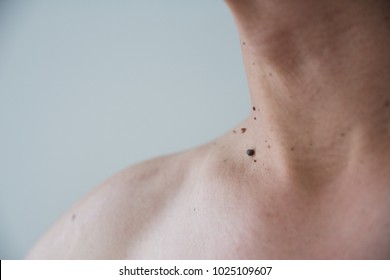 Mole Or Wart On The Men Skin