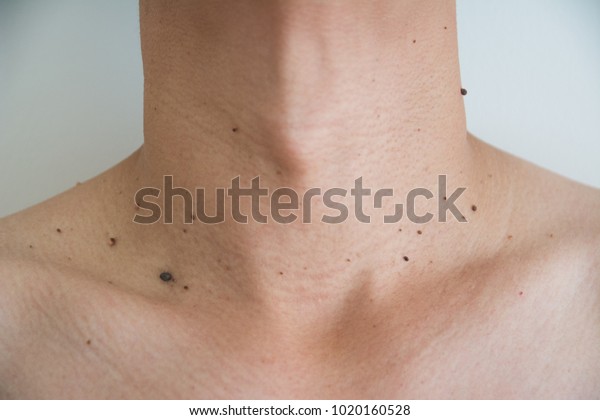 Mole or wart on the men
skin
