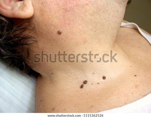How to remove papilloma on neck Papilloma on your neck