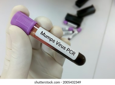 Molecular Biologist Hold Blood Sample For Mumps Virus PCR Test. Blur Background