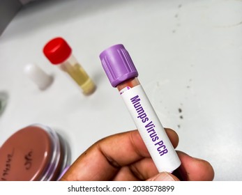 Molecular Biologist Hold Blood Sample For Mumps Virus PCR Test. Laboratory Background