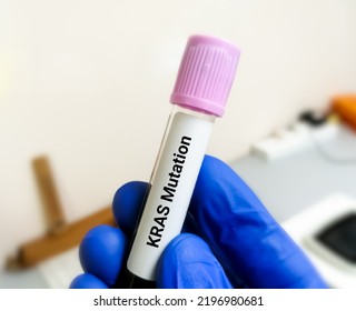 Molecular Biologist Hold Blood Sample For  KRAS Mutation Test For Lung Cancer.