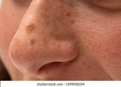 Moles And Freckles Are Seen Close Up In Macro Detail, On The Nose Of A Caucasian Person, Fair Skin With Open Pores At Risk Of Skin Cancer And Disease.