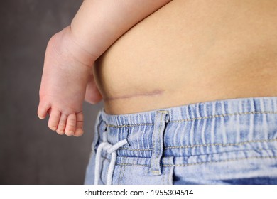 Mom With A Baby In Arms, The Scar Of A Cesarean Operation On Stomach