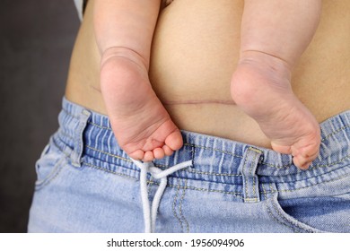 Mom With A Baby In Arms, The Scar Of A Cesarean Operation On Stomach