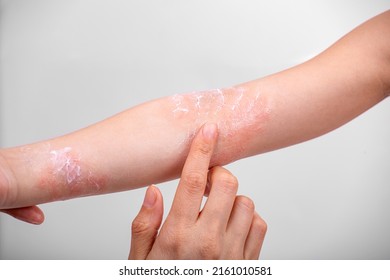 Mom Smears Cream On The Hand Of A Child With Atopic Dermatitis. Hands Close-up