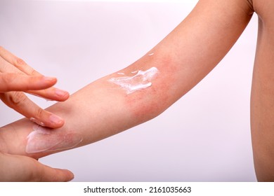 Mom Smears Cream On The Hand Of A Child With Atopic Dermatitis. Hands Close-up