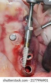 The Moment Before Installing The Dental Implant In The Template