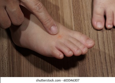 Mommy!! Insects Bit Me. A Hand And A Foot Of Baby. A Finger Of Mother Point To An Insect Bite Button On The Foot. Red Button From Insect Or Mosquito Bite Is Under Healing Gel.