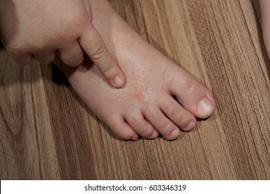 Mommy!! Insects Bit Me. A Hand And A Foot Of Baby. A Finger Of Baby Point To An Insect Bite Button On The Foot. Red Button From Insect Or Mosquito Bite Is Under Healing Gel.