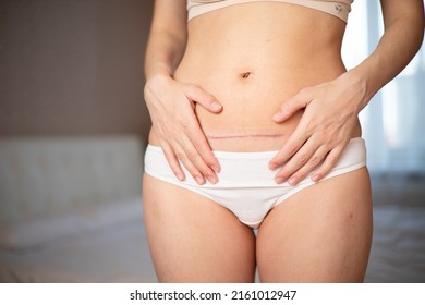 Mom's abdomen after cesarean section. Scar seam. bodypositive diversity Real motherhood. Lifestyle. High quality photo - Shutterstock ID 2161012947