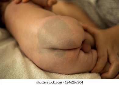 Mongolian Spot Is A Type Of Birthmarks