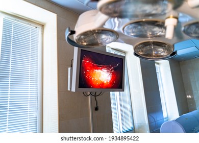 Monitor In Operation Room With Surgery Process On. Neurosurgery Operation Seen On Screen. Closeup.