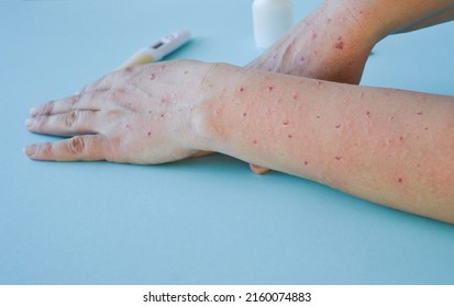 Monkey pox virus, a new world problem of modern humanity. Close-up of the hands of a sick person with pimples and blisters. Smallpox vaccine.