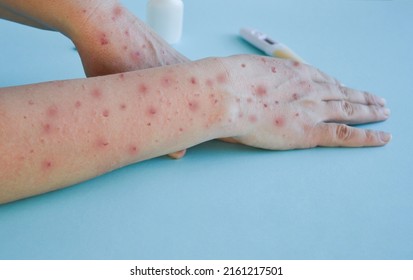Monkey pox virus, a new world problem of modern humanity. Close-up of the hands of a sick person with pimples and blisters. Smallpox vaccine. - Shutterstock ID 2161217501