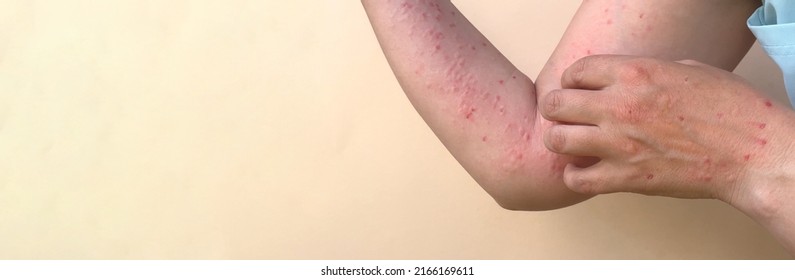 Monkey pox virus, a new world problem of modern humanity. Banner with hands of a sick person with pimples and blisters. Smallpox vaccine.