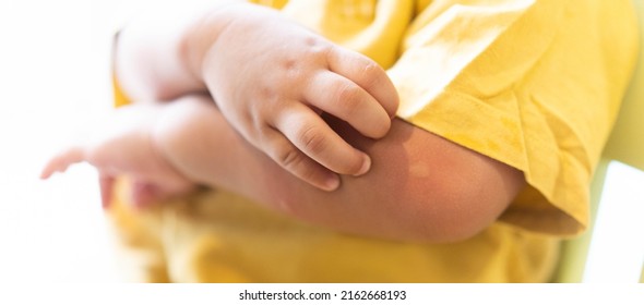 Monkeypox Infection Pandemic.African Kid Child Hand Symptom Pox On Monkeypox Infection.Monkeypox Is A Rare Disease Infection With Virus.kid Health.infection In South America.Mosquito Bite.dengue Fever